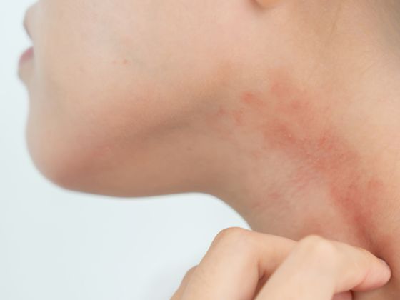 A person’s hand touching a recurring, dry, red, and inflamed rash on their neck.